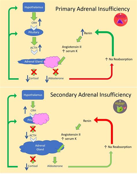 primary  secondary adrenal insufficiency pathophysiology primary