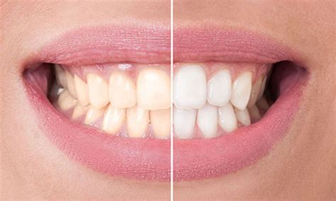 tooth bleaching reduce plaque  gingivitis  systematic review dentistry