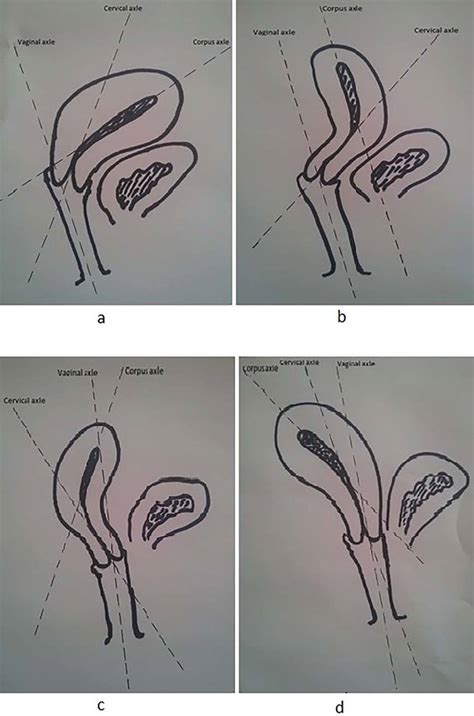 different uterine anatomical positions except rare positions a