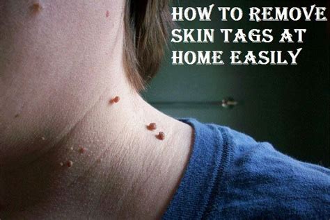 how to remove skin tags at home using home remedies to get rid of preauricular skin tag ear