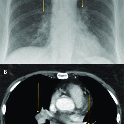 Images A And B Show Bilateral Hilar Lymphadenopathy On Chest X Ray