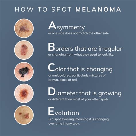 facts  melanoma dermphysicians   england