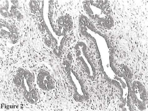 histopathologic appearance of the right breast biopsy of