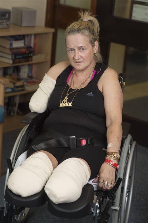 Scheme Tv Star Annie Caddis Has Both Legs And Right Arm Amputated After