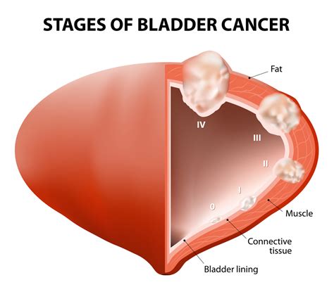 urologic cancer types symptoms stages diagnosis treatments
