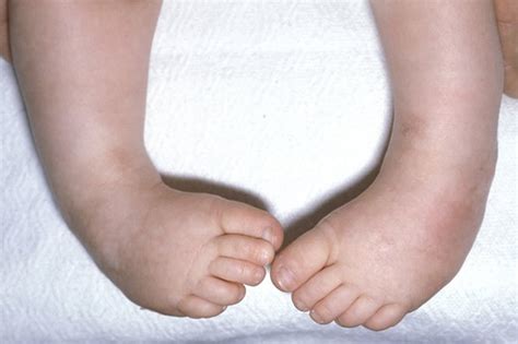 club foot congenital clubfoot  types symptoms treatment