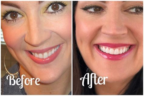 Invisalign Treatment Wrap Up Video Before And Afters