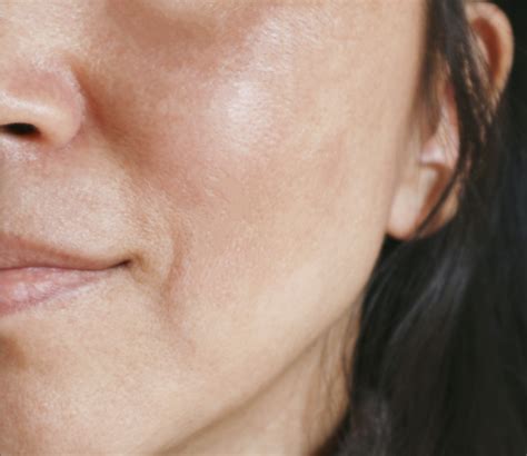 measuring facial skin thickness dermatology times