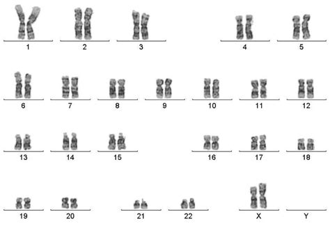 Karyotype Showing 46 X I Xq Chromosomal Complement Download