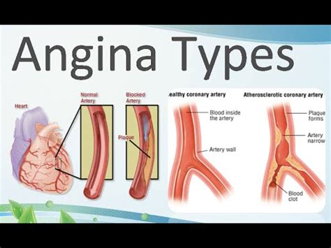 angina pectoris types youtube