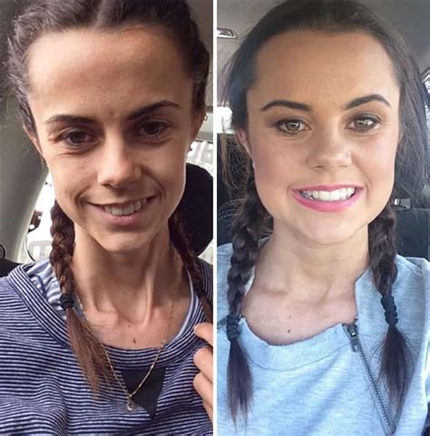 45 ‘before And After’ Photos Of People Who Beat Anorexia True Activist