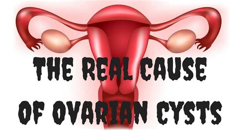ovarian cysts symptoms the real cause of ovarian cysts ovarian cyst