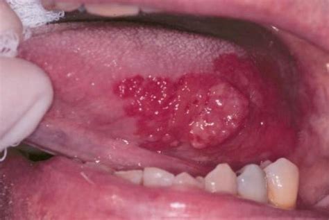 floor lesions mouth photo