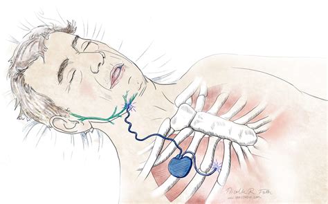 chest implant  sleep apnea portfolio sayostudio
