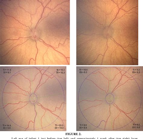 figure   evolution   disease  retinopathy  prematurity