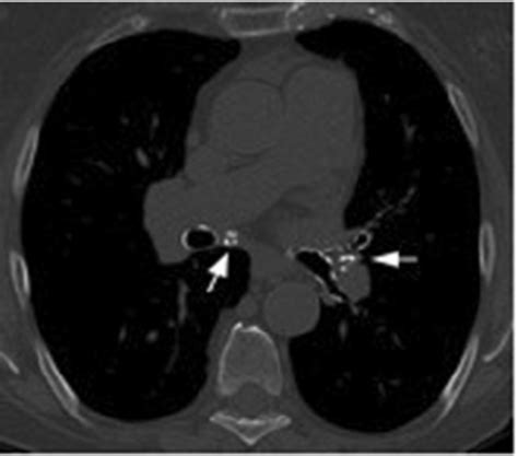 A 69 Year Old Female With Calcified Hilar Lymph Nodes