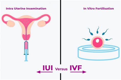Difference Between Ivf And Artificial Insemination