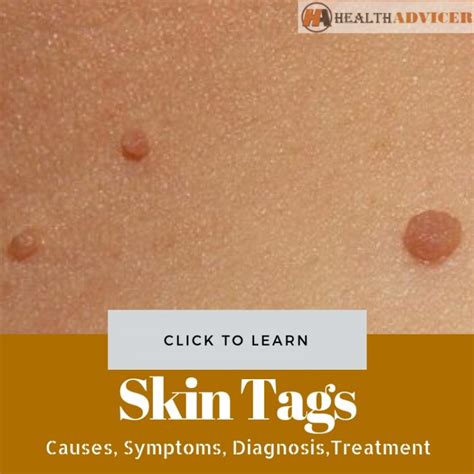 skin tags causes picture symptoms and treatment
