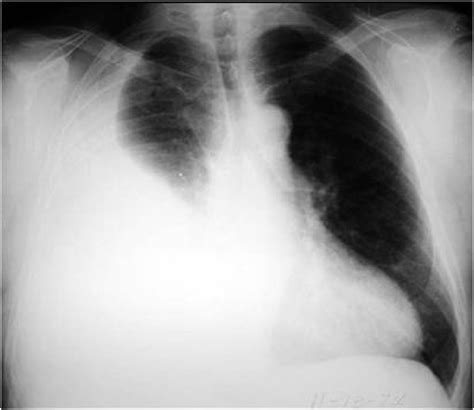 Ovarian Hyperstimulation Syndrome With Pleural Effusion A Case Report
