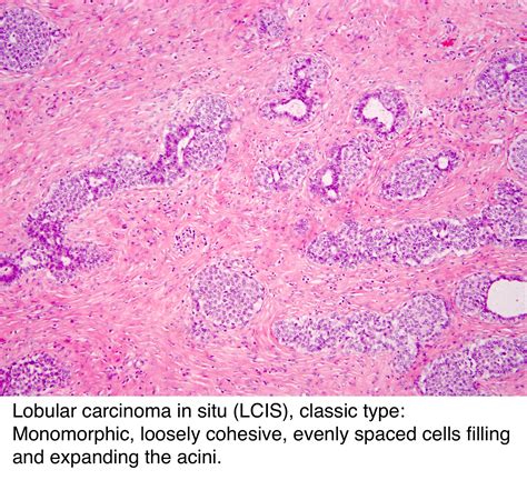 pathology outlines who classification