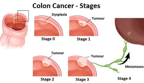 colon cancer causes diagnosis and treatment