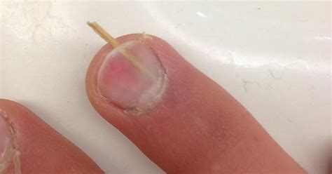 Got A Splinter Stuck Under My Fingernail Imgur