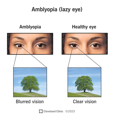 lazy eye amblyopia symptoms  treatment