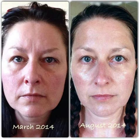 galvanic spa results   week   months facial spa