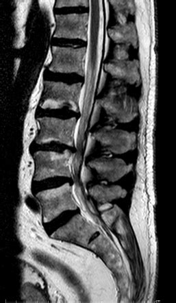 spinal dural calcification image radiopaediaorg