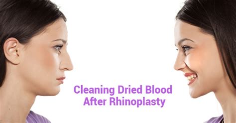 clean  dried blood  rhinoplasty dr