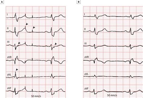 Uncommon Etiology Of Abnormal Spikes On Electrocardiogram Cardiology