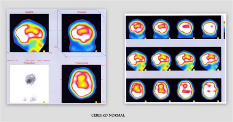 la gammagrafia de perfusion cerebral  spect cerebral cdi marbella