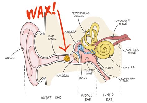 tinnitus vector illustration labeled shingles noise perception ear