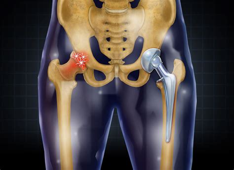 Hip Repalcement Surgery Hospital In Pune India Sancheti Hospital
