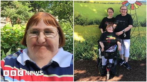 disability blogger trolls said i was too ugly for selfies so i hit