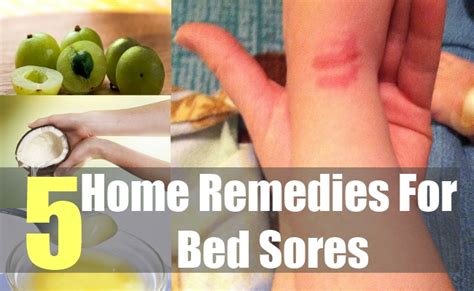 5 Best Home Remedies For Bed Sores Natural Home Remedies And Supplements