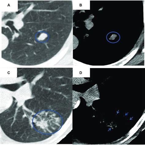 Comparison Of Two Mediastinal Features Between Benign And Malignant