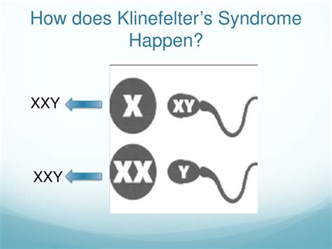 Klinefelter S Syndrome Screen 4 On Flowvella Presenta