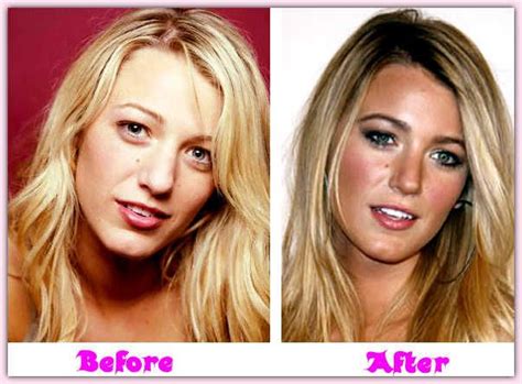 blake lively before and after nose blake lively plastic surgery plastic surgery photos