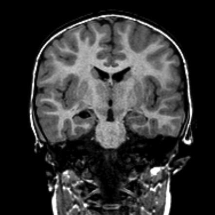 choroidal fissure cyst radiology reference article radiopaediaorg