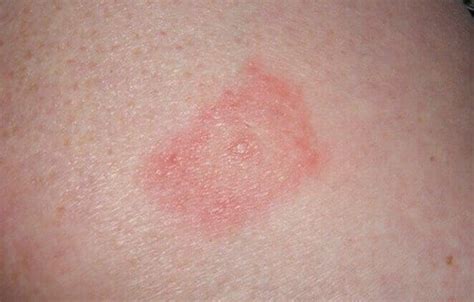 Lyme Disease Causes 3 Symptoms Treatment And Prevention 2022