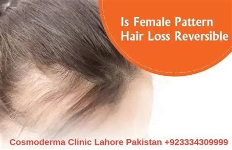 female pattern hair loss treatment  lahore pakistan  options
