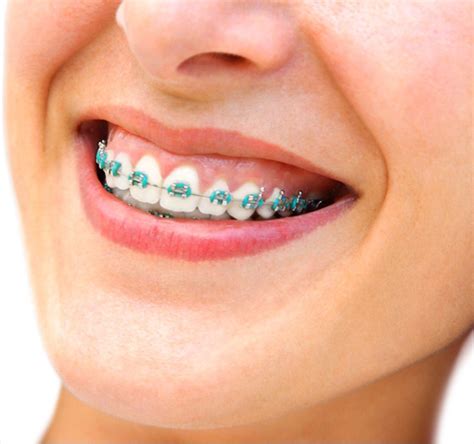 √ Braces Color Teal