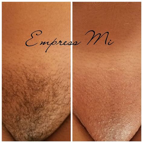 Collection Of Pubic Brazilian Wax Before And After Photos