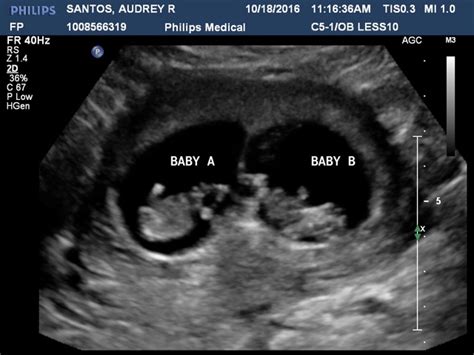 I M Expecting Twins This Was My First Ultrasound At 10 Weeks 3 Days