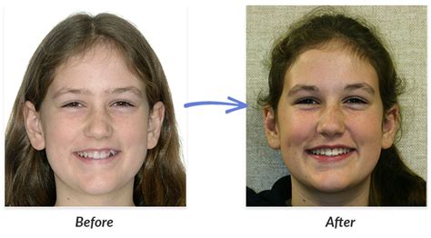 Braces In Adults Before And After Before And After