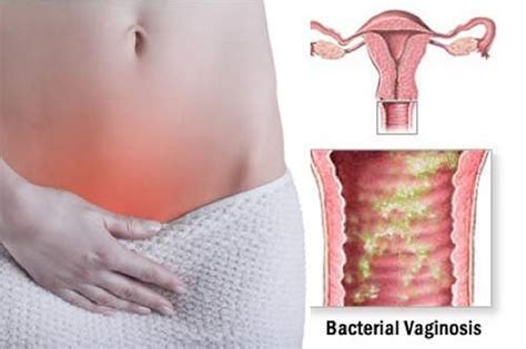 bacterial vaginosis causes symptoms diagnosis