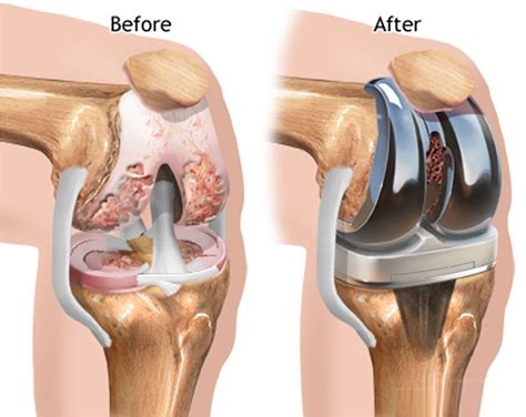 total knee replacement  mumbai dr ashit shah