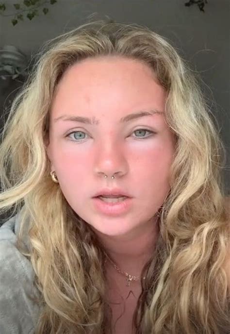 Woman Baffled As She Pokes Her Extremely Swollen Face Leaving A Huge