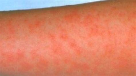 Scarlet Fever Sharp Rise In Cases Since Christmas Bbc News